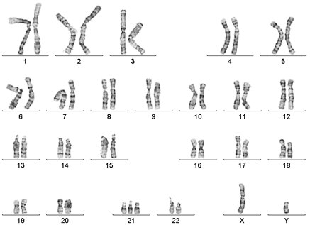 L'ARN miR-155 codé par le troisième chromosome 21 bloque la synthèse de la protéine SNX27, causant des troubles de l’apprentissage.