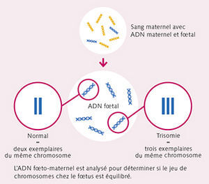 ADN libre foetal pour dépister les anomalies chromosomiques