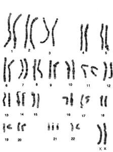 T21: Caryotype d'une fille ayant trois chromosomes 21