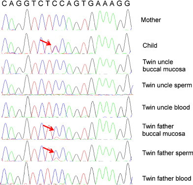Le test de paternité a permis de différencier l'ADN de deux frères jumeaux monozygotes